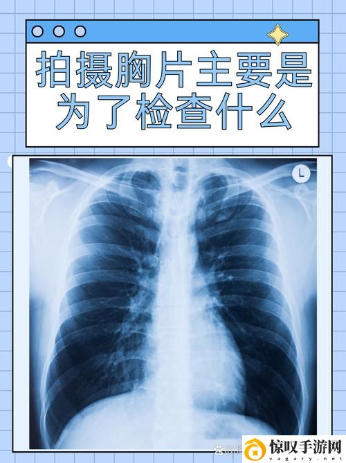 100%胸片曝光率软件可以直接看